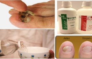 Elimina los hongos de las uñas con una pasada y hacer que crezcan