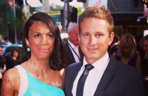 Sufrió quemaduras y su novio nunca la dejó. Años después sucede algo que te sacará lágrimas