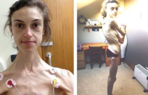 “Instagram me salvó la vida”: La impresionante transformación de Emelle, una joven que luchó durante años contra la anorexia