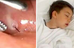 Hijo casi muere después de comer la hamburguesa de la madre – da la voz de alarma para advertir a otros