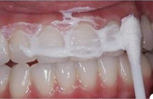 Un amigo dentista me enseñó a eliminar el sarro, la gingivitis y blanquear mis dientes en minutos