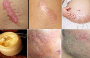 Elimina las cicatrices de cualquier parte de tu cuerpo en menos de un mes con este remedio totalmente natural