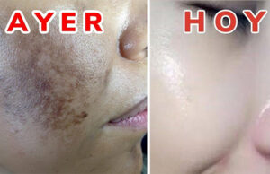 Tenía muchas manchas en su rostro y las eliminó con una receta maravillosa