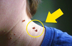 Cómo eliminar una verruga rápidamente