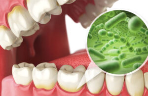 Remedios caseros para combatir el mal aliento