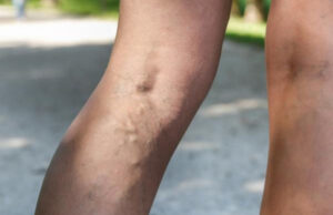 Cómo lidiar efectivamente con trombosis venosa profunda