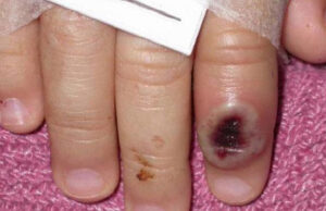 Detectado un primer caso de viruela del mono en Suiza