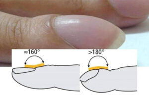 Preocúpate si tus dedos se ven de esta manera