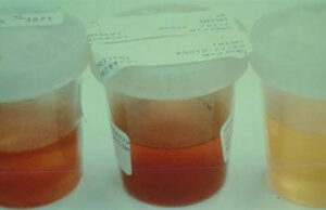 El color de tu orina revela todo sobre tu salud