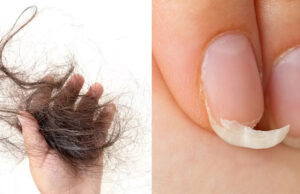 Caída de Cabello y uñas quebrantadas