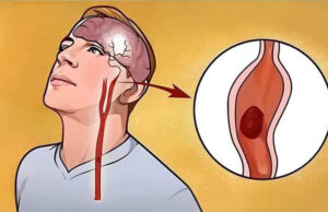Un derrame te avisa un mes antes, el cuerpo te lo advierte por medio de estas 10 señales