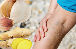 Ajo y Jengibre para Várices: Remedio Natural Efectivo