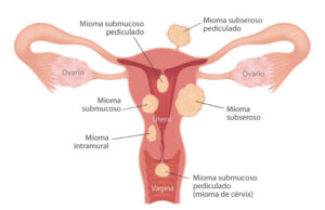 Los miomas uterinos
